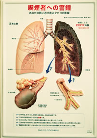 タバコはぜんそくや肺癌だけでなく、花粉症にも悪い影響を及ぼす。